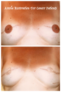 Nipple-areola regimentation mastectomy patients breast